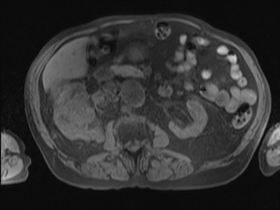 Adénocarcinome rénal droit avec envahissement de la veine rénale et de la VCI T1 FS axial