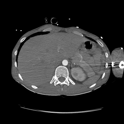 Severe cranioencephalic injuries, Carotid artery dissection, Aspiration pneumonia, Pelvic fracture Chest, Abdomen and Pelvis, Arterial phase, Axial plane