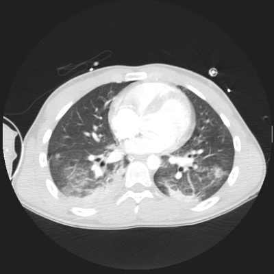 Cranioencephalic trauma, Facial fracture, Thoracic injuries, Pelvic fracture, Spleen and renal trauma Chest CT, Lung window, Axial plane