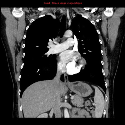 Veine cave supérieure gauche et retour veineux pulmonaire anormal partiel  TDM Thorax Coronal