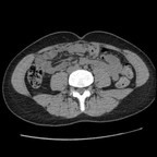 Maladie de Cacchi Ricci TDM Abdomen Pelvis Axial Sans injection Maladie de Cacchi Ricci TDM Abdomen Pelvis Axial Sans injection