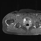 Tendinopathie du moyen glutéal IRM axial Tendinopathie du moyen glutéal IRM axial