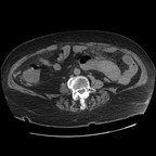 Hématome pariétal jéjunal Axial Hématome pariétal jéjunal Axial