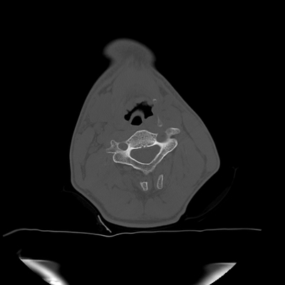 Thoracic Injuries, Spinal Injuries L5, Traumatic disc herniation Cervical spine, Axial plane, Bone window