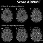 Echelle ARWMC (Age-Related White Matter Changes) Score-ARWMC-Leucopathie-substance-blanche-IRM Echelle ARWMC (Age-Related White Matter Changes) Score-ARWMC-Leucopathie-substance-blanche-IRM