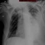 Drain pleural en position péricardique Radiographie Thorax Face Drain pleural en position péricardique Radiographie Thorax Face
