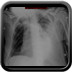 Drain pleural en position péricardique  Radiographie Thorax Face