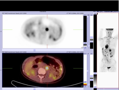Phéochromocytome et paragangliome dans un contexte de maladie de Von Hippel Lindau ser1000img00002