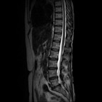 Hernie discale foraminale L5-S1 gauche, Modic 1 Sagittal T2 Hernie discale foraminale L5-S1 gauche, Modic 1 Sagittal T2