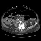Syndrome occlusif par anse incarcérée volvulée sur bride avec signes de souffrance. TDM Abdomen Axial Temps veineux Syndrome occlusif par anse incarcérée volvulée sur bride avec signes de souffrance. TDM Abdomen Axial Temps veineux