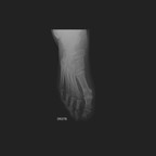 Fracture de contrainte épiphysaire distale tibiale associée à une ténosynovite distale du tendon tibial postérieur et à un épaississement cicatriciel du faisceau profond du ligament deltoïdien d'origine post-traumatique. Radiographie Pied Face Fracture de contrainte épiphysaire distale tibiale associée à une ténosynovite distale du tendon tibial postérieur et à un épaississement cicatriciel du faisceau profond du ligament deltoïdien d'origine post-traumatique. Radiographie Pied Face