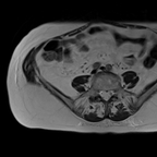 IRM en faveur d'un polype endométrial, avec accouchement par le col. Cependant un cancer du col ne peut être exclu en IRM : à confronter à une vérification histologique. AXT2 Grand Champ IRM en faveur d'un polype endométrial, avec accouchement par le col. Cependant un cancer du col ne peut être exclu en IRM : à confronter à une vérification histologique. AXT2 Grand Champ
