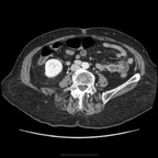 Cholecystite fistulisée avec abcès TDM Pelvis Axial Temps veineux Cholecystite fistulisée avec abcès TDM Pelvis Axial Temps veineux