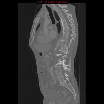 Hydatidose thoracique, hépatique et splénique avec nodules pulmonaires excavés  TDM Abdomen Sagittal Fenêtre Os