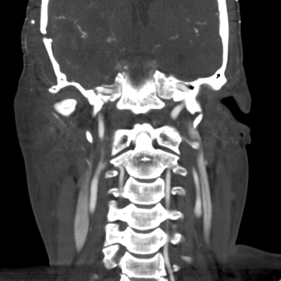 Severe cranioencephalic injuries, Carotid artery dissection, Aspiration pneumonia, Pelvic fracture Neck vessels, Coronal plane