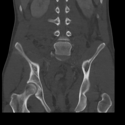 traumatisme cranien, fracture du massif facial, traumatisme thoracique, fracture pelvienne, traumatisme spléno-rénal bassin coro os