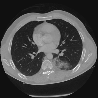 Thoracic Injuries, Spinal Injuries L5, Traumatic disc herniation Chest CT, Lung window, Axial plane