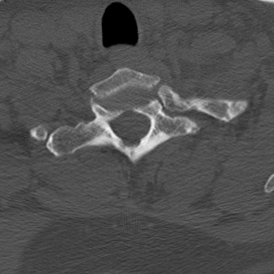 Subarachnoid Hemorrhage, Traumatic, Pneumothorax, Sternum fracture Cervical spine LOWER axial plane bone window
