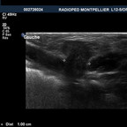 Hernie inguinale utéro ovarienne Echographie inguinale Hernie inguinale utéro ovarienne Echographie inguinale