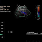 Syndrome du défilé thoraco-brachial artériel gauche. Echographie-Doppler du membre supérieur Syndrome du défilé thoraco-brachial artériel gauche. Echographie-Doppler du membre supérieur