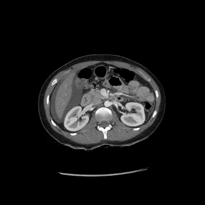 Abdominal vessels trauma, Intraperitoneal bladder rupture, Spleen infarction, Pelvic fracture Chest, Abdomen and Pelvis, Arterial phase, Axial plane