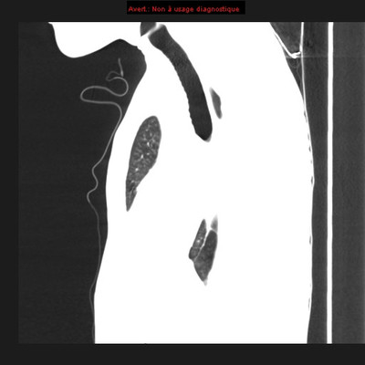 Déficit immunitaire commun variable : micronodules centrolobulaires sur bronchiolite  TDM Thorax Sagittal