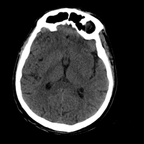 Occipital Condyle Fracture, Thoracic injuries, Hepatic trauma, Adrenal hemorrhage Head CT, Axial plane, Soft tissue window Occipital Condyle Fracture, Thoracic injuries, Hepatic trauma, Adrenal hemorrhage Head CT, Axial plane, Soft tissue window