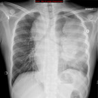 Lymphome de Hodgkin thoracique Radiographie Thorax Lymphome de Hodgkin thoracique Radiographie Thorax