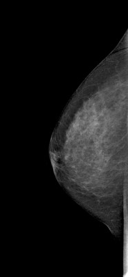 Carcinome canalaire in situ supéro-médian droit RML Acqusition Tomo