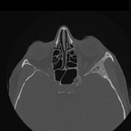 Dysplasie fibreuse cranio faciale gauche. TDM Crâne Axial Fenêtre Os Dysplasie fibreuse cranio faciale gauche. TDM Crâne Axial Fenêtre Os