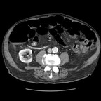 Syndrome occlusif sur cancer colique de l'angle gauche. TDM Abdomen Pelvis Axial temps portal Syndrome occlusif sur cancer colique de l'angle gauche. TDM Abdomen Pelvis Axial temps portal