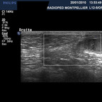 Torsion d'hydatide de Morgagni US inguino-scrotale Torsion d'hydatide de Morgagni US inguino-scrotale