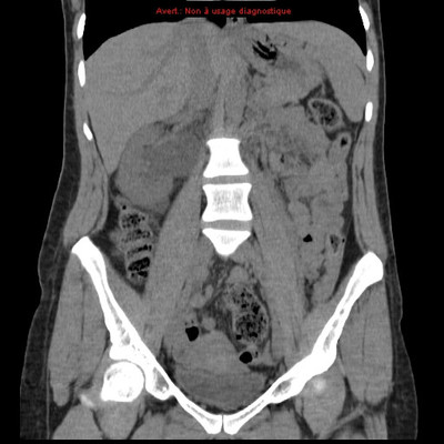 colique néphrétique droite sur calcul du méat urétéral  TDM Abdomen Pelvis Coronal Sans injection