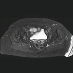 Iliotibial trak disruption T2 FS TSE DIXON AXIAL_W Iliotibial trak disruption T2 FS TSE DIXON AXIAL_W