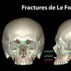 Fractures de la face lefort-fracture-skull-classification-fr Fractures de la face lefort-fracture-skull-classification-fr
