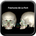 Fractures de la face lefort-fracture-skull-classification-fr