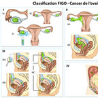 Cancer de l’ovaire FIGO-Classification-Ovaire-Cancer Cancer de l’ovaire FIGO-Classification-Ovaire-Cancer