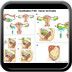 Cancer de l’ovaire FIGO-Classification-Ovaire-Cancer