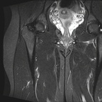 Déchirure musculaire IRM hanche coronal STIR Déchirure musculaire IRM hanche coronal STIR