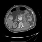 Rupture d'un anévrysme de l'aorte abdominale. TDM Thorax abdomino pelvien Axial Temps artériel Rupture d'un anévrysme de l'aorte abdominale. TDM Thorax abdomino pelvien Axial Temps artériel