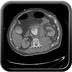 Rupture d'un anévrysme de l'aorte abdominale.  TDM Thorax abdomino pelvien Axial Temps artériel