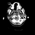 Hématome épidural cervical étendu avec fracture horizontal de l'arc antérieur de C1 se prologeant à l'articulaire droite avec fracture du condyle occipital gauche. Rachis + encéphale mou Hématome épidural cervical étendu avec fracture horizontal de l'arc antérieur de C1 se prologeant à l'articulaire droite avec fracture du condyle occipital gauche. Rachis + encéphale mou