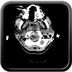 Hématome épidural cervical étendu avec fracture horizontal de l'arc antérieur de C1 se prologeant à l'articulaire droite avec fracture du condyle occipital gauche. Rachis + encéphale mou