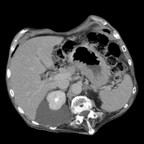 Hernie hiatale par roulement. TDM Abdomen Axial Temps veineux Hernie hiatale par roulement. TDM Abdomen Axial Temps veineux