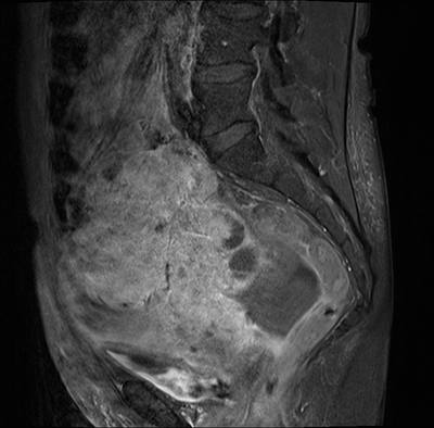 Cystadénocarcinome ovarien séro-papillaire moyennement différencié Stade IIIb Sagittal T1 Fat Sat