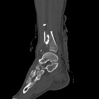 Occipital Condyle Fracture, Thoracic injuries, Hepatic trauma, Adrenal hemorrhage Right ankle, Sagittal plane, Bone window