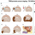 Prostate Cancer Staging TNM-staging-prostate-cancer Prostate Cancer Staging TNM-staging-prostate-cancer