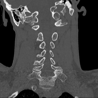 Thoracic Injuries, Spinal Injuries L5, Traumatic disc herniation Cervical spine, Coronal plane, Bone window