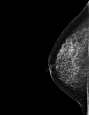 Carcinome canalaire in situ supéro-médian droit RML