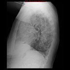 Pneumopathie interstitielle fibrosante à la cordarone Radiographie Thorax F+P Pneumopathie interstitielle fibrosante à la cordarone Radiographie Thorax F+P